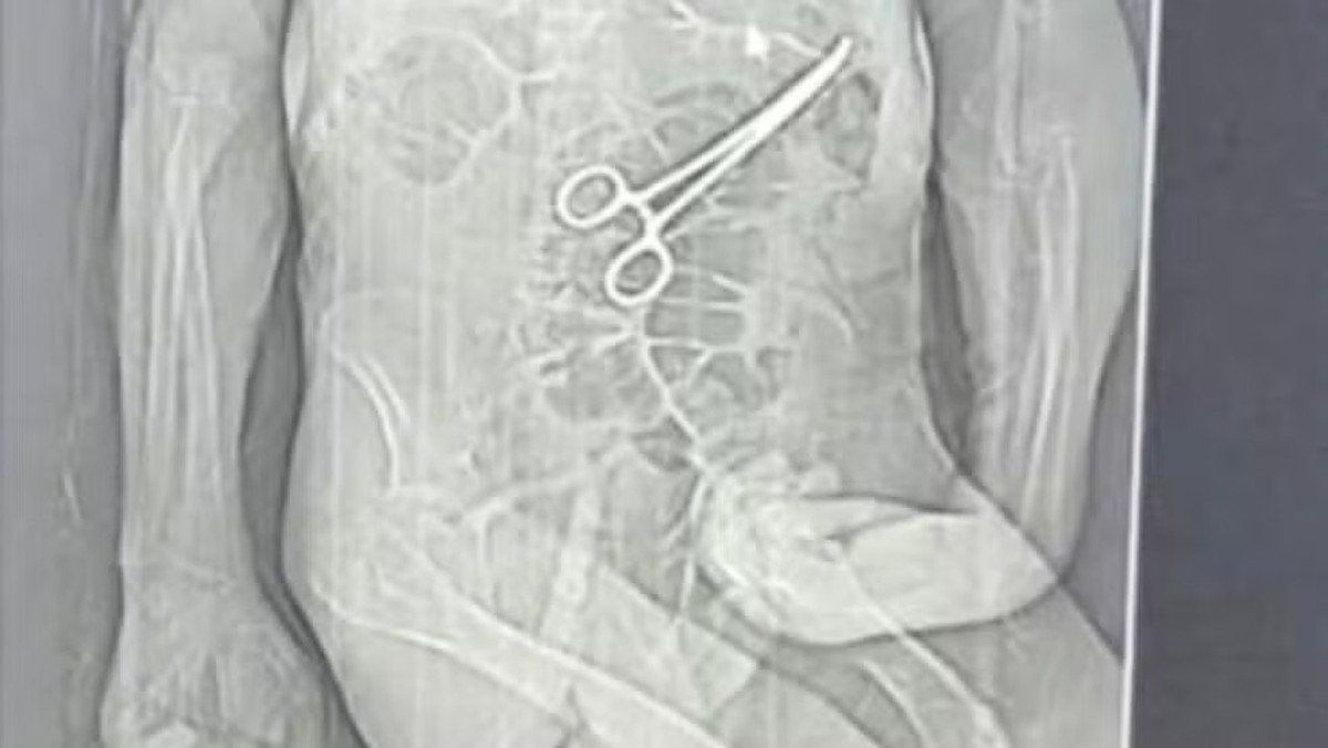 Secretaria de Saúde investiga morte de idoso que teve instrumento cirúrgico esquecido dentro do corpo em MG