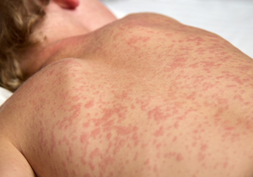 Ministério da Saúde confirma primeiro caso de sarampo importado deste ano em São Paulo