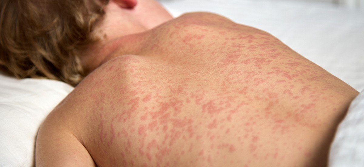 Ministério da Saúde confirma primeiro caso de sarampo importado deste ano em São Paulo